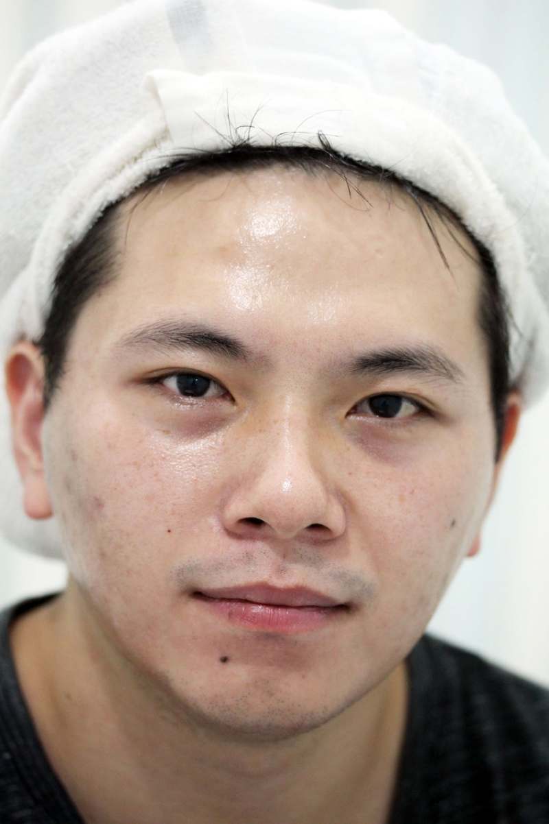 嘉義劉怡慧皮膚科 雷射除痘疤
