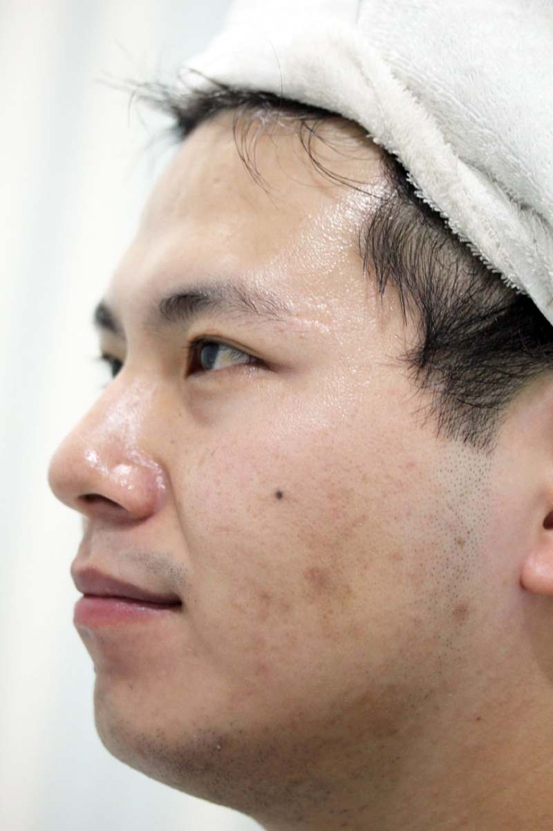 嘉義劉怡慧皮膚科 雷射除痘疤