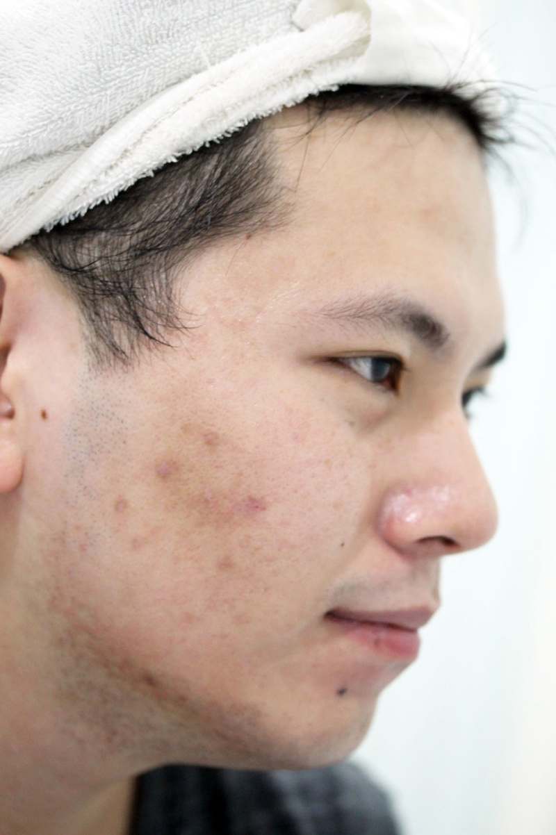 嘉義劉怡慧皮膚科 雷射除痘疤