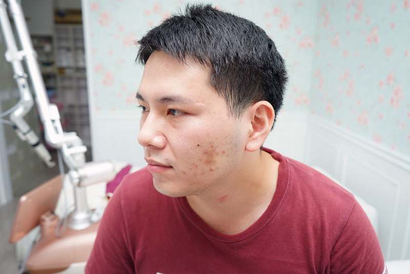 嘉義劉怡慧皮膚科 雷射除痘疤