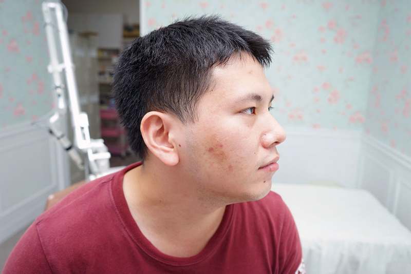 嘉義劉怡慧皮膚科 雷射除痘疤