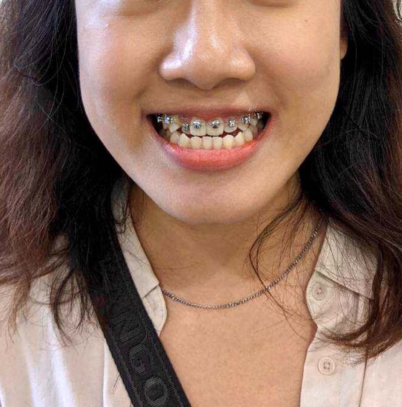 台南光美牙醫 牙套矯正全記錄