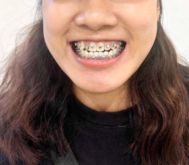 台南光美牙醫 牙套矯正全記錄
